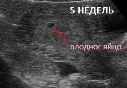 4 тиждень вагітності узі, узі 4 тиждень вагітність фото узі 4 тиждень вагітність фото