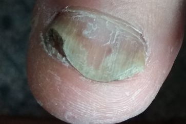 лікування запущеного грибка нігтів на ногах