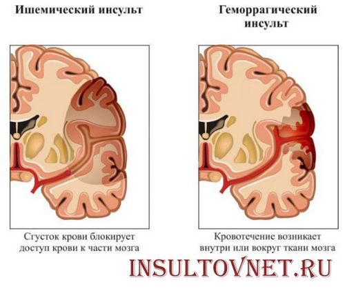 як лікувати галюцинації після інсульту