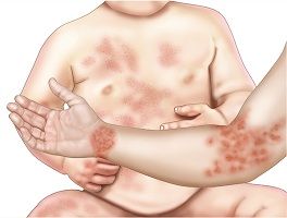 екзема алергія симптоми лікування причини профілактика шкіра висип алергічна дерматит фото