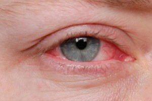 алергічний блефарит симптоми і лікування
