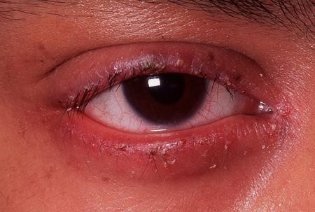 алергічний блефарит симптоми і лікування