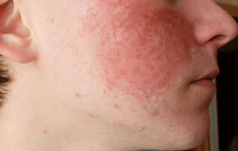 як лікувати алергію шкіри