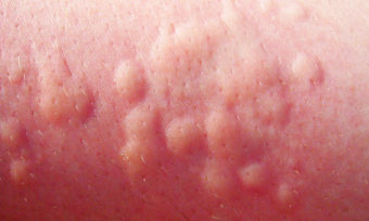 як лікувати алергію шкіри