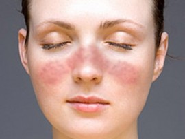 лікувати алергію на обличчі
