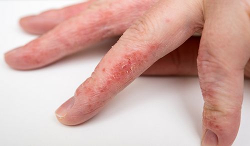 як вилікувати алергію на руках