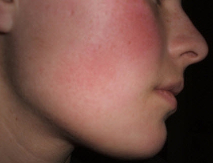 алергія на щоках і вухах дорослих грудних дітей симптоми ніж лікувати