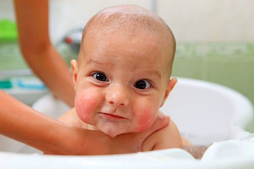 як лікувати алергію у немовляти