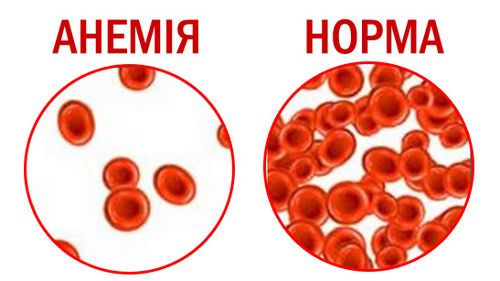 анемія симптоми і лікування у дорослих жінок