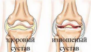 як лікувати артроз 3 стадії