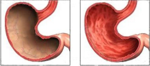 як лікувати атрофію шлунка