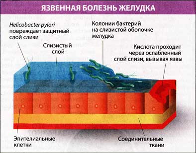 бактерію helicobacter pylori