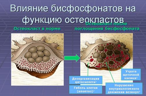 бісфосфонати для лікування остеопорозу ціна