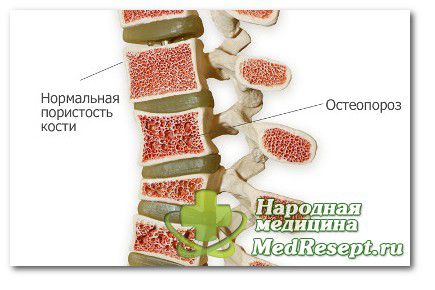 остеопороз лікування
