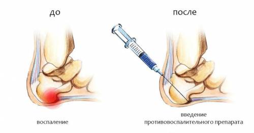 як вилікувати ноги від шпор