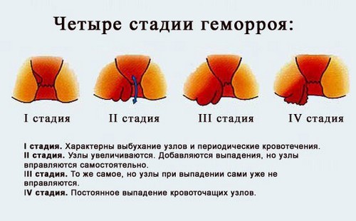 ніж лікувати геморой