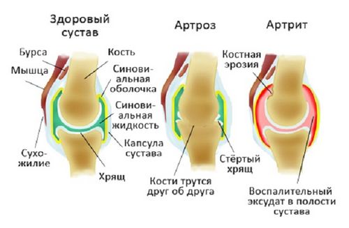 чим відрізняється артрит від артрозу