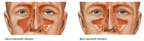чим відрізняється синусит гайморит що таке симптоми