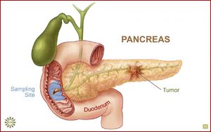 дифузний зміна печінку підшлункової залоза паренхіма