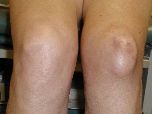 лікування бурситу колінного суглоба