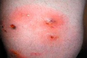 чиряк виглядає фурункул фото симптом ознака діагностика небезпечний фурункульоз запалення лікувати вид хвороба хронічний