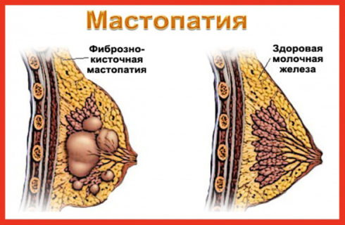 Що таке дифузна фіброзно-кістозна мастопатія, страшно це чи ні як лікувати мастопатію дифузну