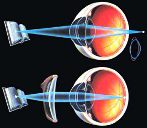 як лікувати очі далекозорість