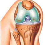 лікувати деформуючий артроз колінних суглобів
