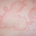 дерматит людина лікування шкіра пошкодження