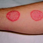 дерматит людина лікування шкіра пошкодження