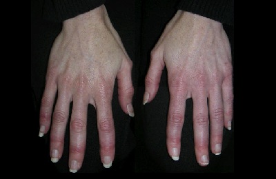 як лікувати дерматит рук