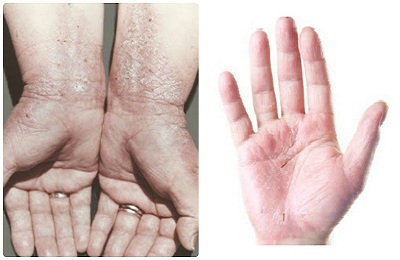 як лікувати дерматит рук