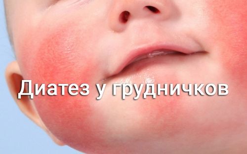 лікувати діатез немовлят народними засобами