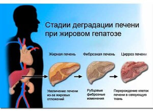 збільшена печінка