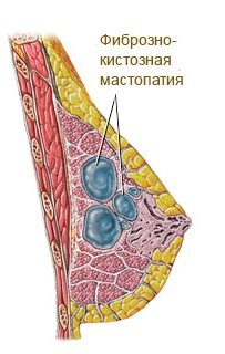 як лікувати фіброзну кісту