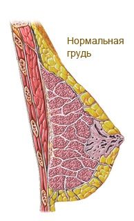 як лікувати фіброзну кісту