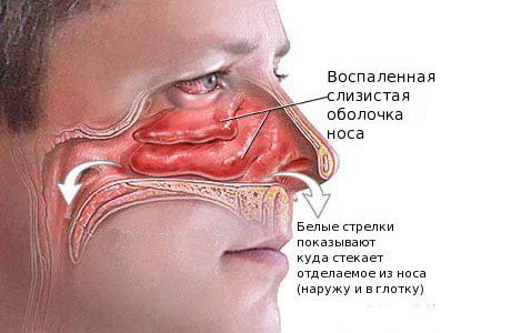 хронічний гайморит болить голова