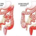 як вилікувати геморой дитині