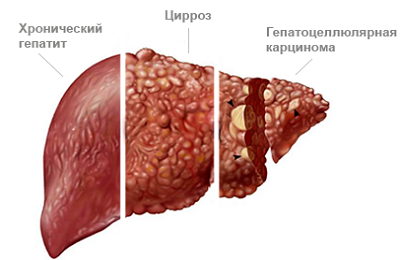 як лікувати печінку від гепатиту