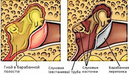 як лікувати хронічний отит у дитини