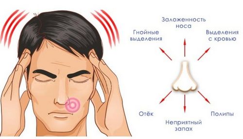 як лікувати грибковий синусит