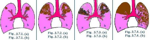 фази інфільтративного туберкульозу