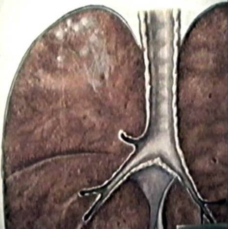 фази інфільтративного туберкульозу