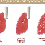 як лікувати інфільтративний туберкульоз