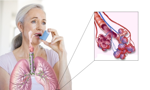 як лікувати початкову стадію астми