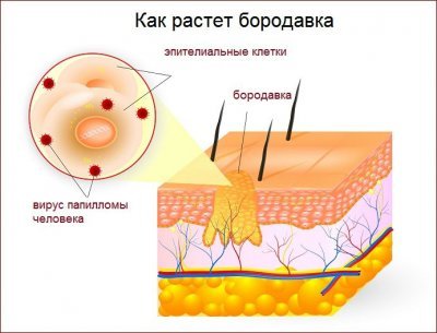 народні засоби від бородавок на руках