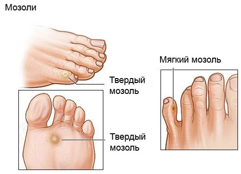 як позбутися мозолів на пальцях ніг