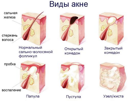 як позбутися від вугрів на носі