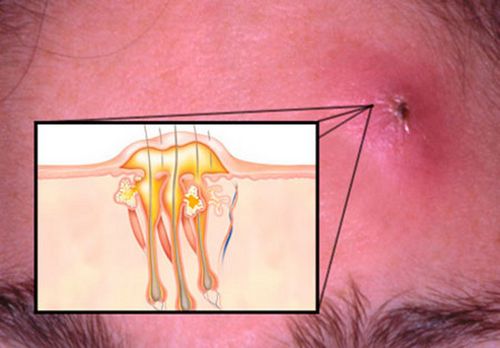 як лікувати фурункул в домашніх умовах