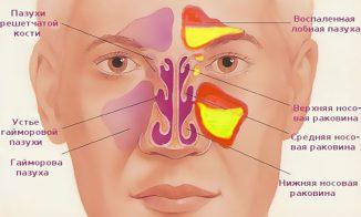 як лікувати верхньощелепної синусит